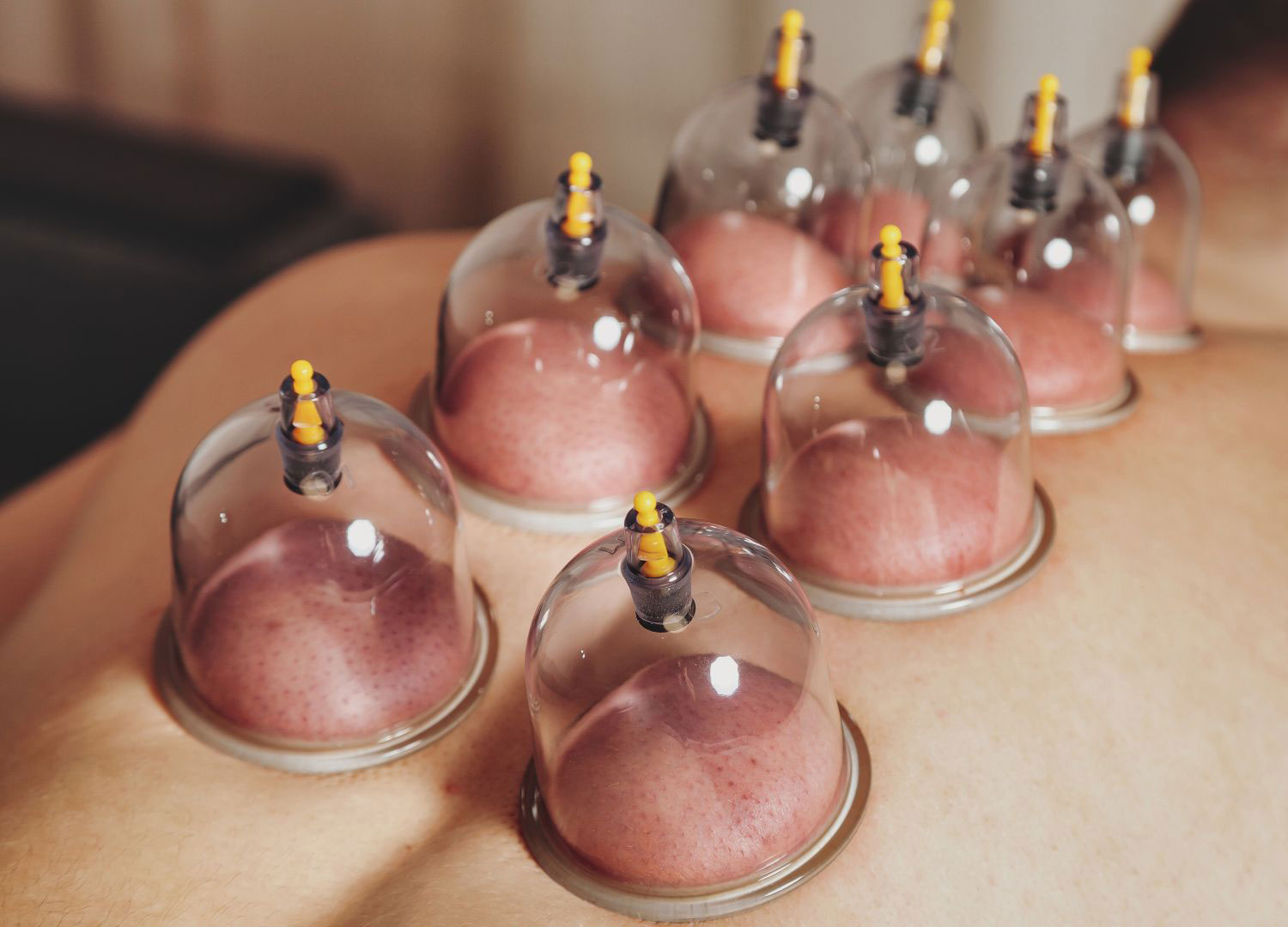 Dry Cupping